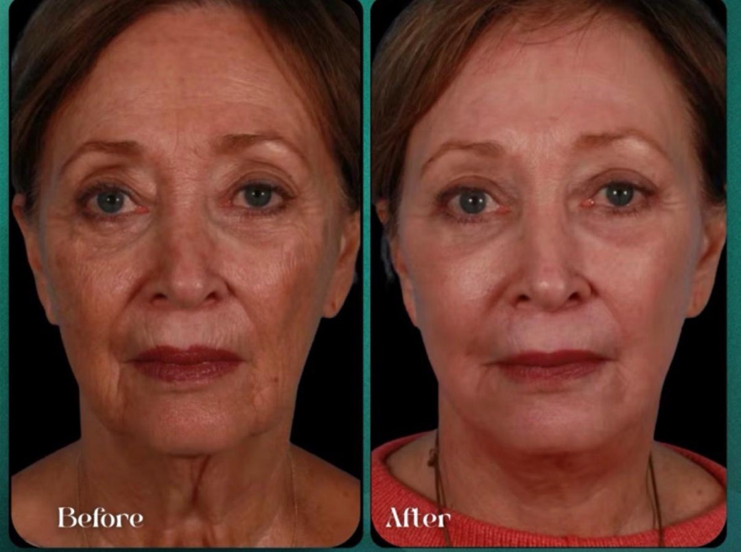Antes y después · rejuvenecimiento facial con Láser No Ablativo
